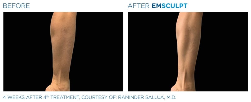 EMSculpt Before and After Legs