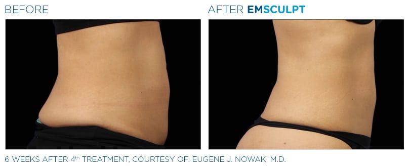 EMSculpt Before and After Stomach