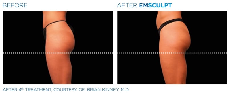 EMSculpt Thighs Before and After