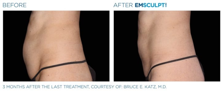 emsculpt muscle toning results women