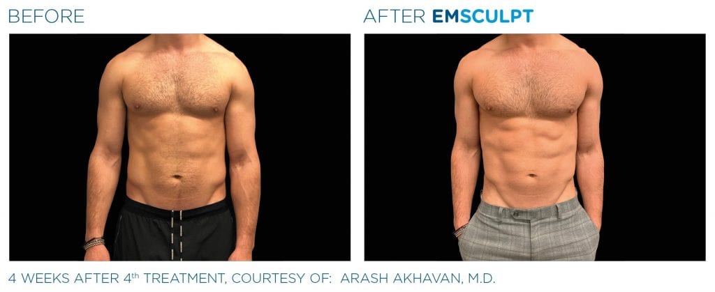 Emsculpt Neo before and after results men
