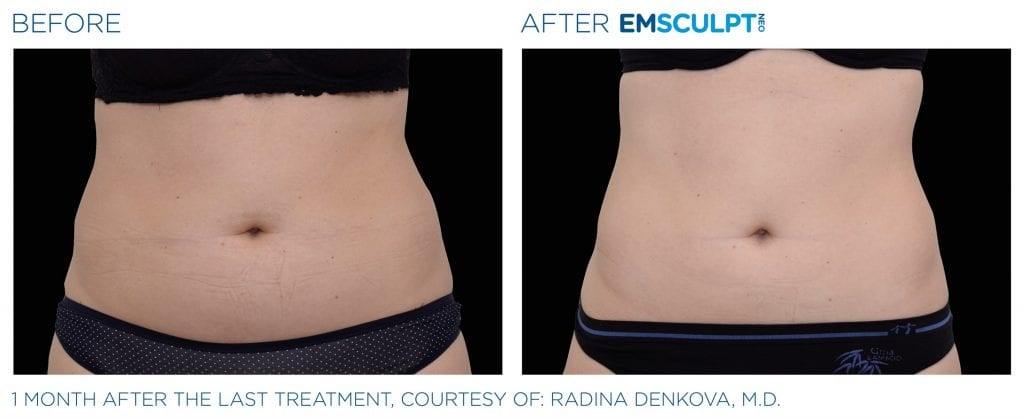 Emsculpt Neo before and after results women