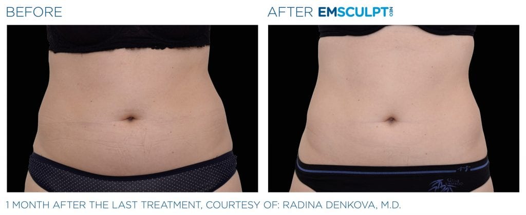 EMSculpt Neo before after results women Emsculpt Neo before and after results women