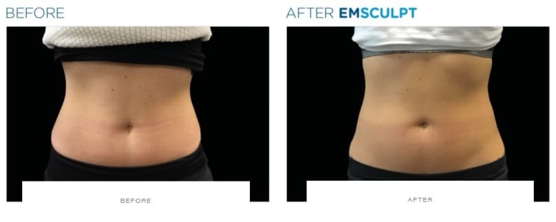 emsculpt before and after abdomen