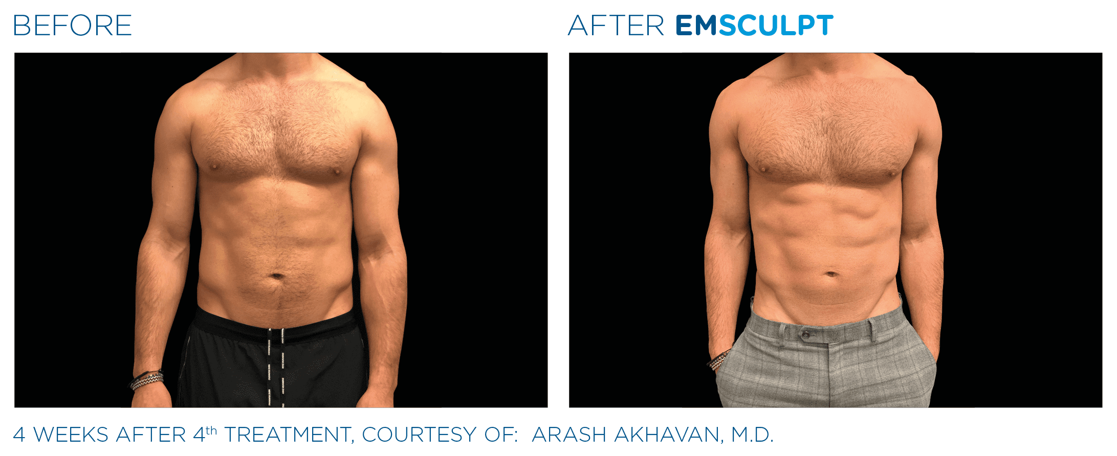 Emsculpt results for men