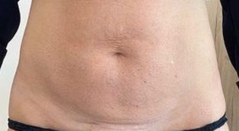 Endolift Before and After Results Sagging Skin Reduction