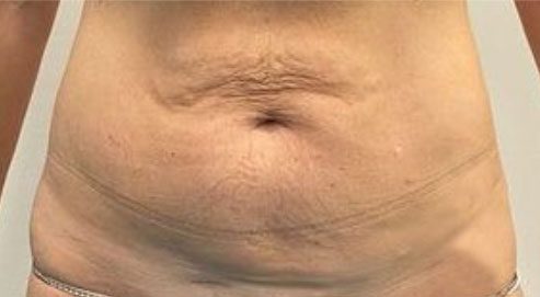 Endolift Before and After Results Sagging Skin Reduction