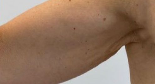 Endolift Before and After Results Wrinkled Arm Reduction