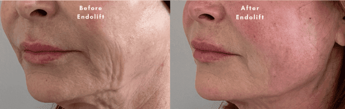 endolift before and after results - medicated weight loss