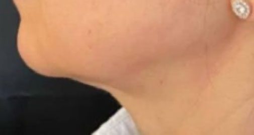 Endolift Before and After Results Jawline Definition