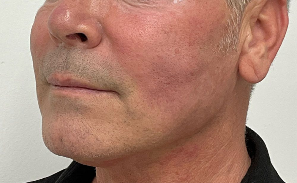 Endolift Before and After Results Male Face Rejuvenation