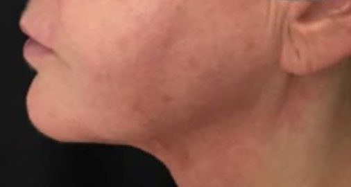 Endolift Before and After Results Jowls Treatment