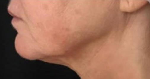 Endolift Before and After Results Jowls Treatment