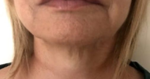 Endolift Before and After Results Sagging Jowls Reduction