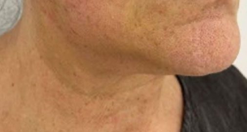 Endolift Before and After Results Sagging Neck Treatment