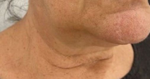 Endolift Before and After Results Sagging Neck Treatment