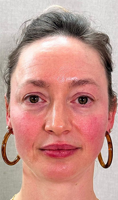 Endolift Before and After Results Female Face Rejuvenation