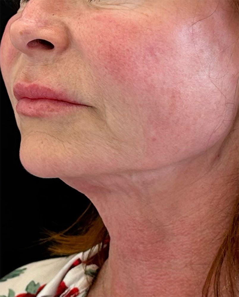 Endolift Before and After Results Neck Rejuvenation
