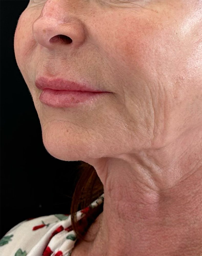 neck wrinkles