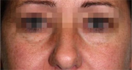 Endolift Before and After Results Eye Sagging Reduction