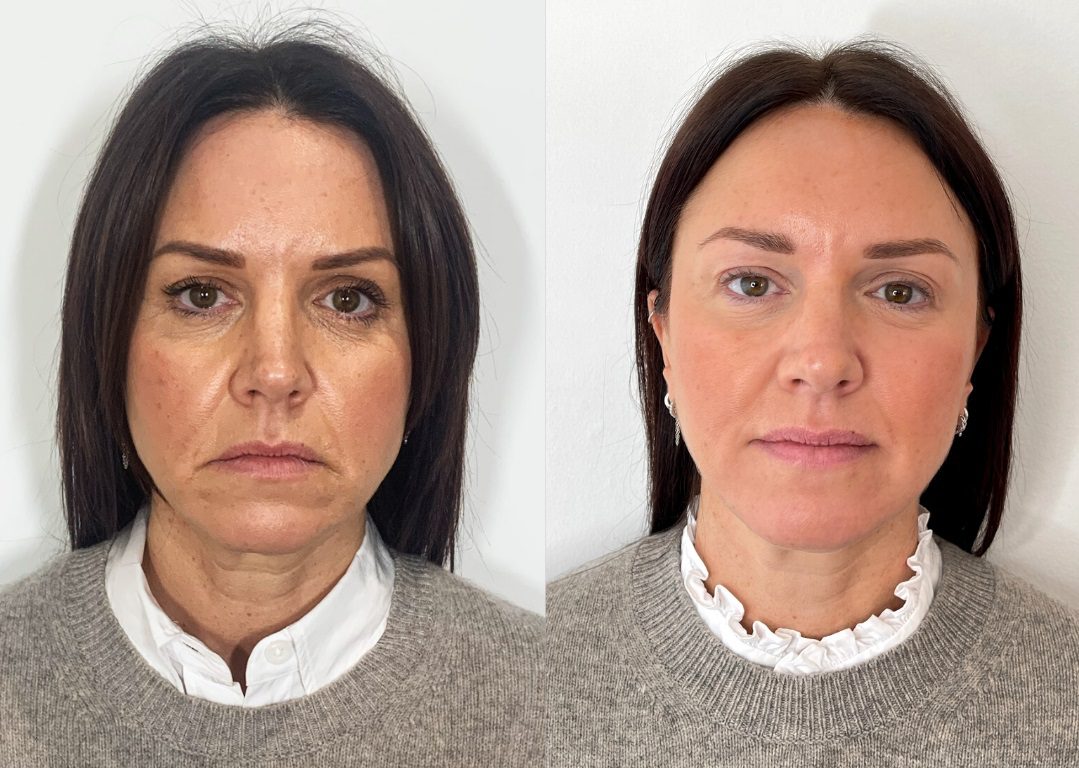facelift with dermal fillers before and after results