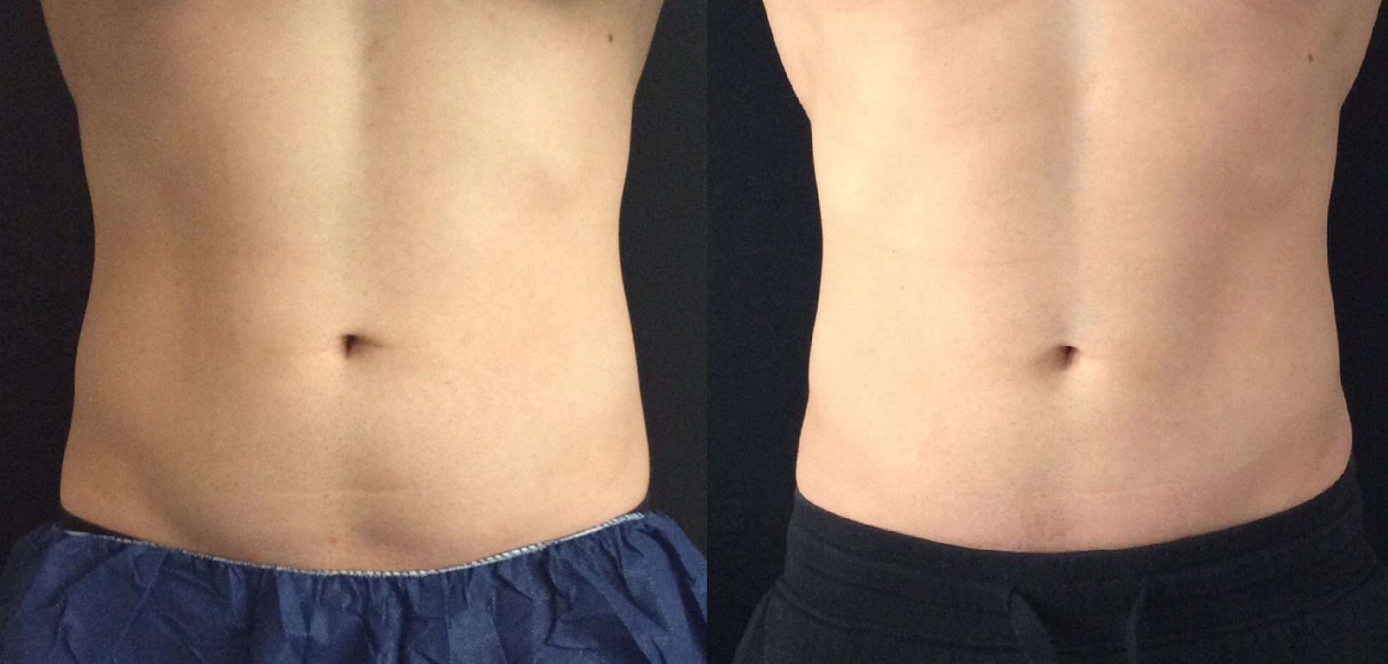 fat freezing abdomen before and after coolsculpting