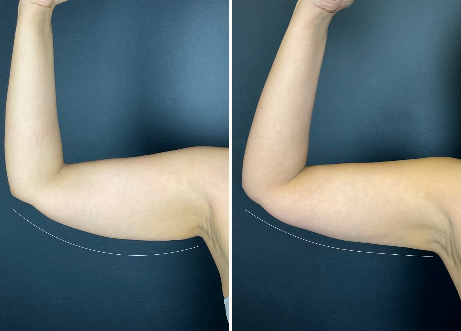 fat freezing coolsculpting arm fat before and after