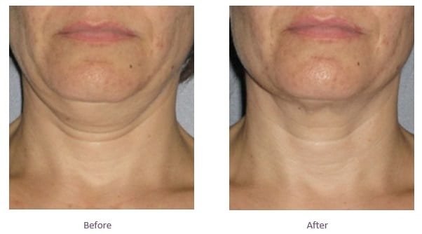 Neck Fat Before and After