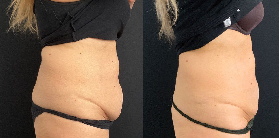 fat removal belly fat tummy coolsculpting fat freezing before and after
