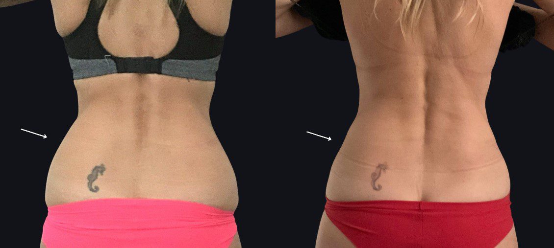 fat removal hips muffin tops coolsculpting before and after