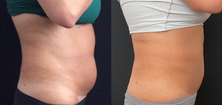 fat removal tummy flanks waist coolsculpting before and after