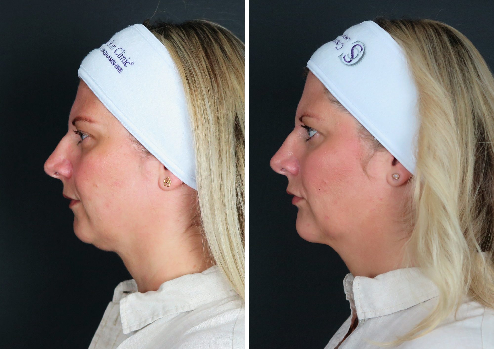 filler cheeks before and after results