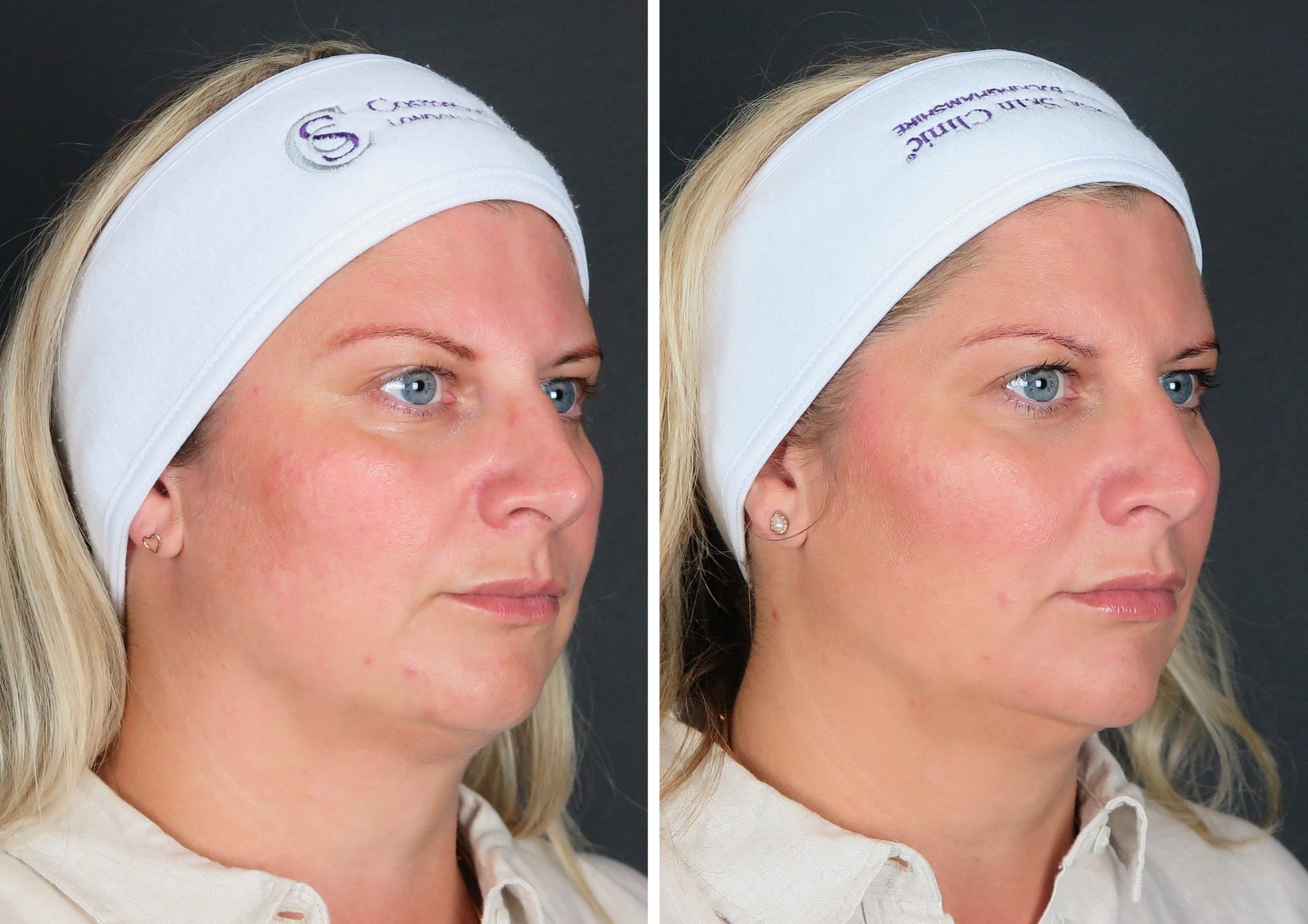filler in the cheeks - before and after results