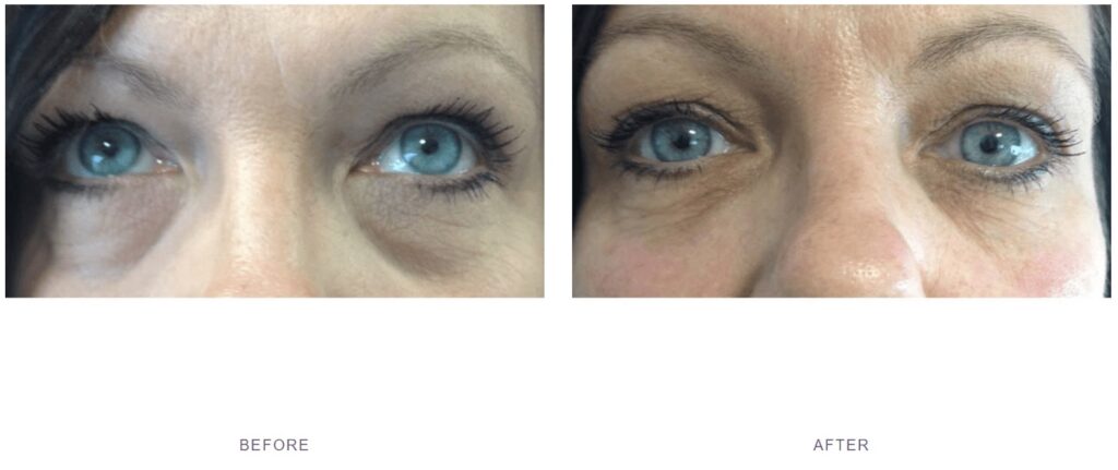 filler tear trough before after or polynucleotides under eyes