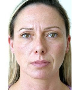 forhead lines botox before