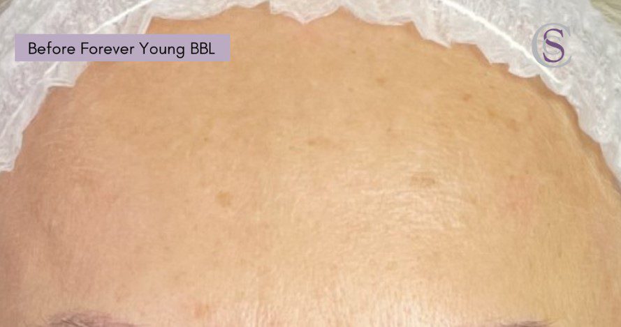 forever young bbl age spots before