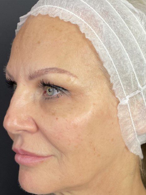 forever young bbl before