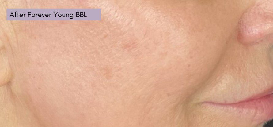 forever young bbl for age spots after