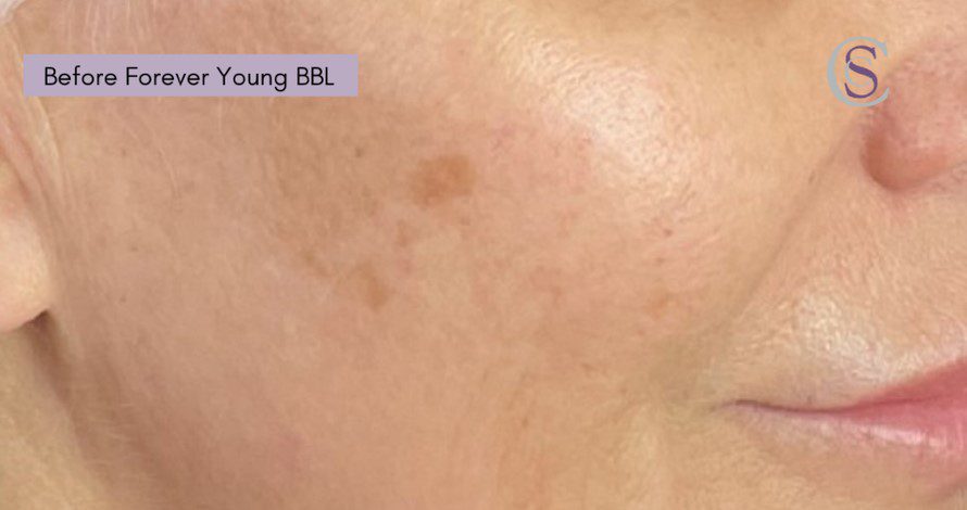 forever young bbl for age spots before