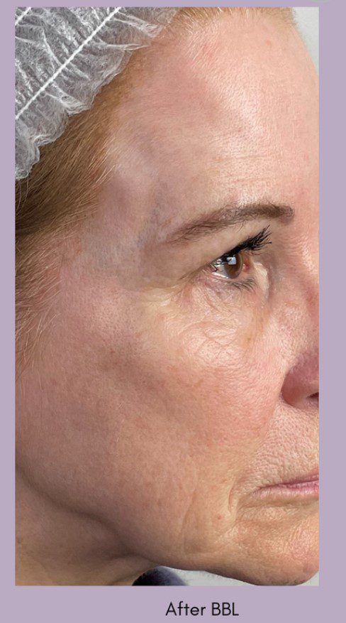 forever young bbl for age spots wrinkles after