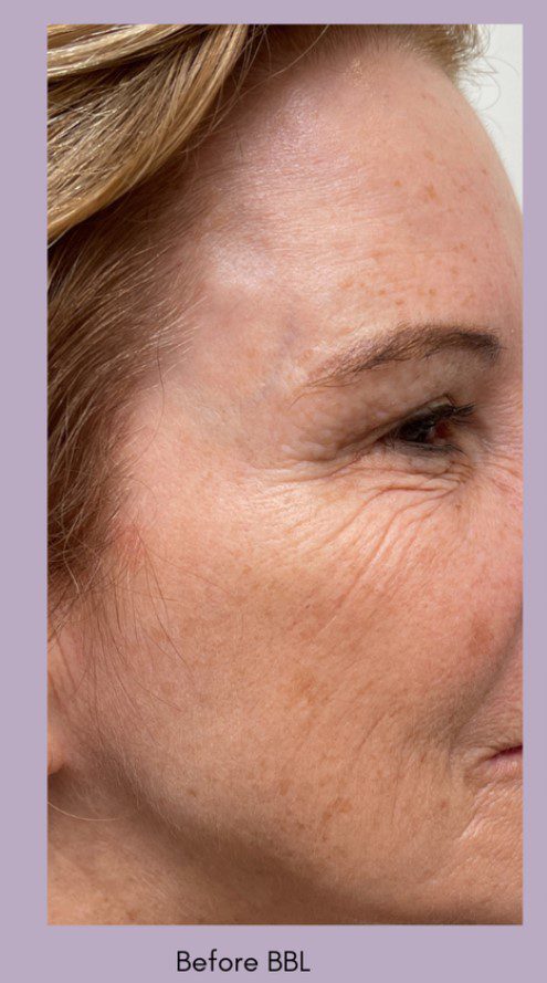 forever young bbl for age spots wrinkles before