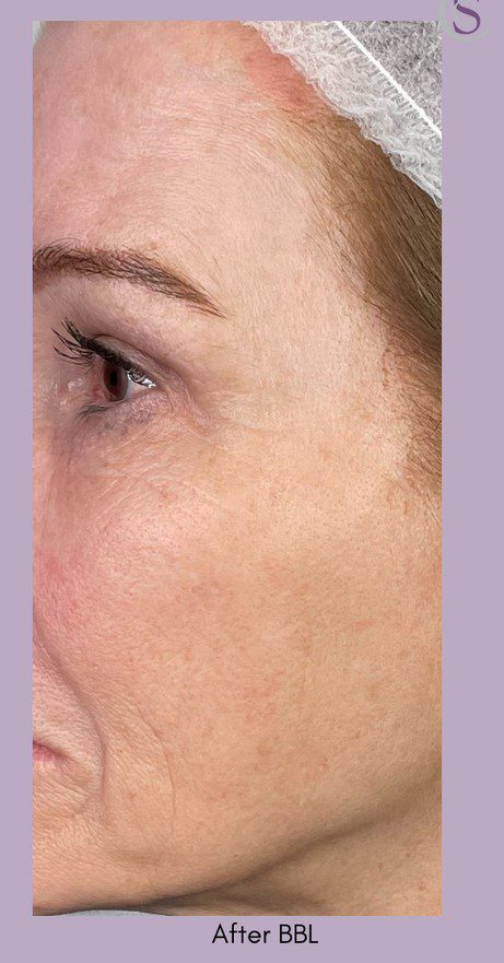 forever young bbl -patient with wrinkles age spots after