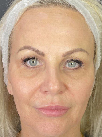 forever young bbl skin pigmentation before