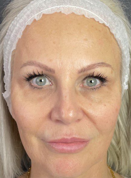 forever young bbl skin pigmentation before