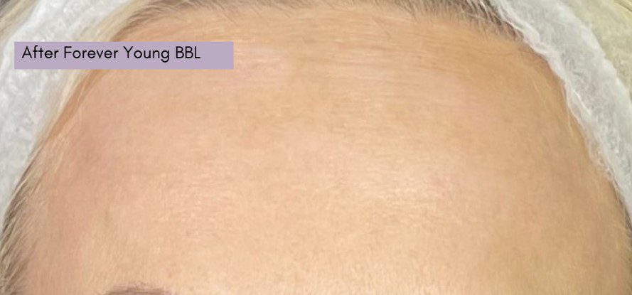 forever young bbl treat age spots after