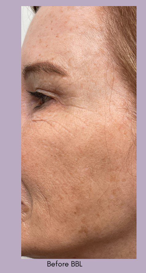 forever young bbl treatment wrinkles age spots before