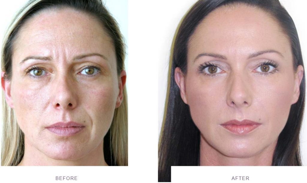frown lines nose to mouth lines restylane before after