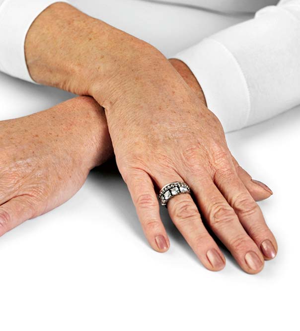Hands after micro injections of Restylane Skinboosters to hydrate the skin