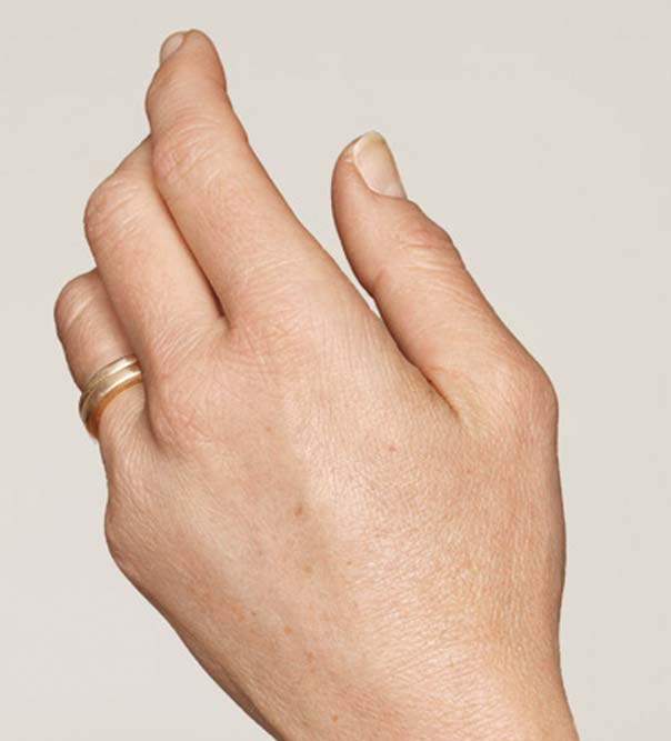 A hand after having micro injections of Restylane Skinboosters