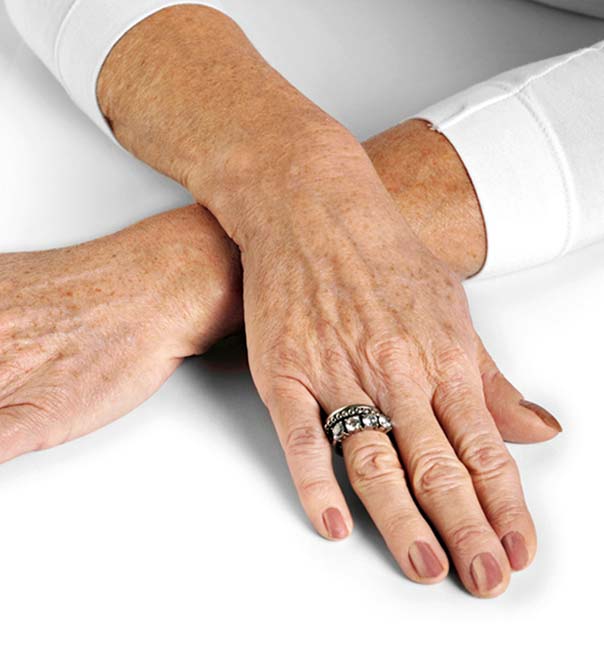 A lady's hands before undergoing hand rejuvenation treatment